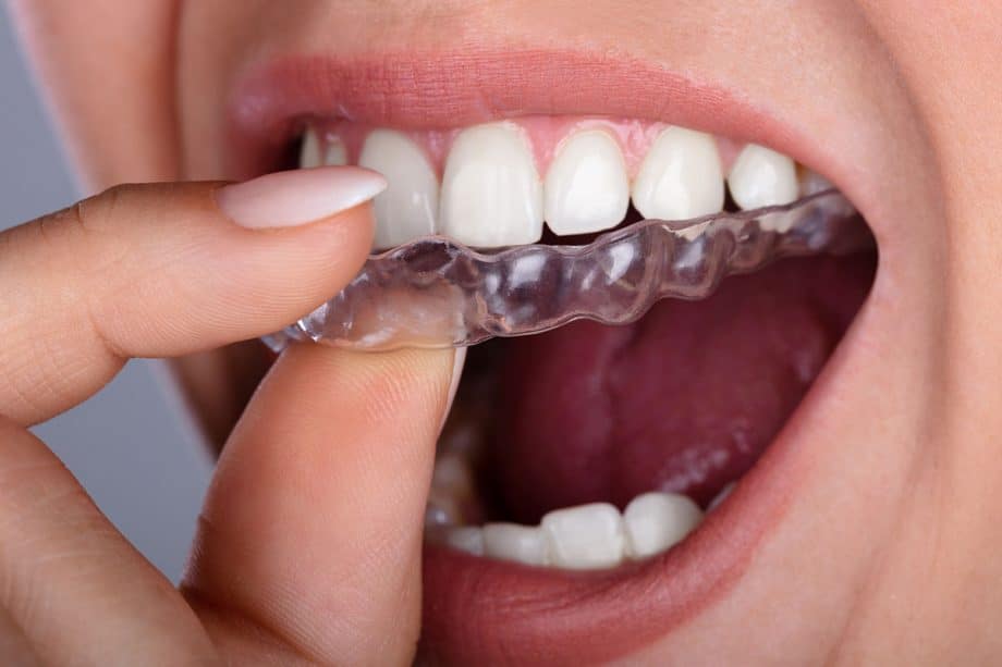 How Long Does Invisalign Take to Straighten Teeth?