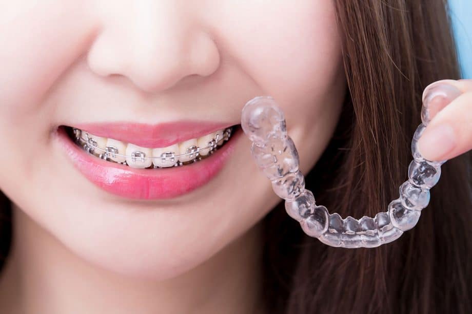 How Much Do Braces Cost in Conover, NC?